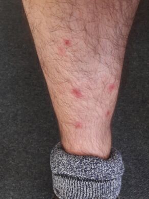 Bed Bugs Bristol